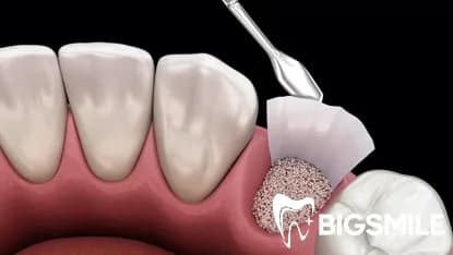 Sinus Lift & Bone Grafting
