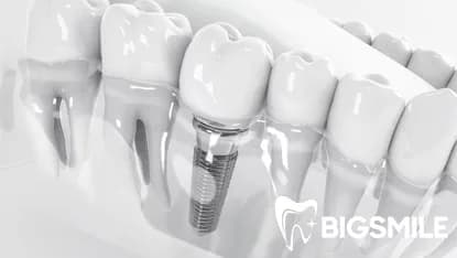Dental Implants